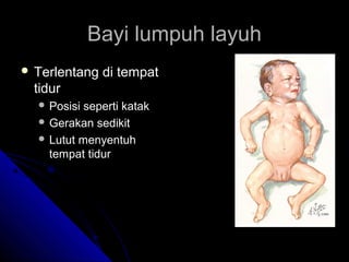 Bayi lumpuh layuh
 Terlentang

di tempat

tidur
 Posisi

seperti katak
 Gerakan sedikit
 Lutut menyentuh
tempat tidur

 