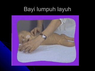 Bayi lumpuh layuh

 
