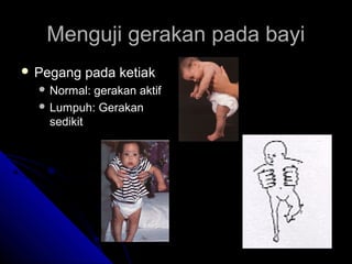 Menguji gerakan pada bayi
 Pegang

pada ketiak

 Normal:

gerakan aktif
 Lumpuh: Gerakan
sedikit

 