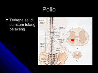 Polio
 Terkena

sel di
sumsum tulang
belakang

 