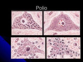 Polio

 
