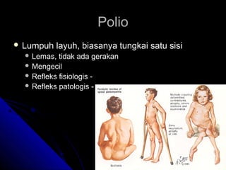 Polio
 Lumpuh

layuh, biasanya tungkai satu sisi

 Lemas,

tidak ada gerakan
 Mengecil
 Refleks fisiologis  Refleks patologis -

 