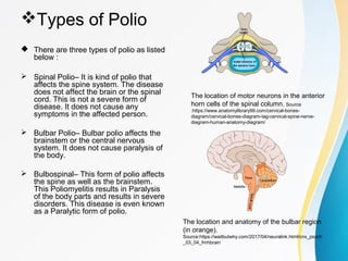 Polio | PPT