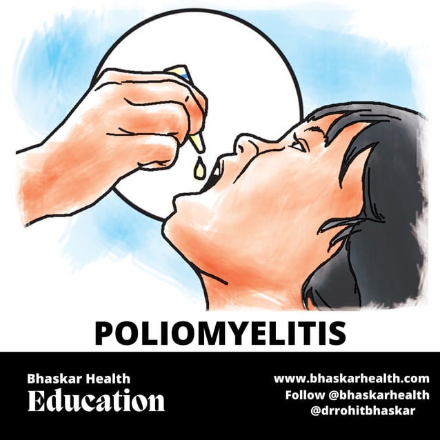 Polio (Poliomyelitis) Physiotherapy Treatment PDF