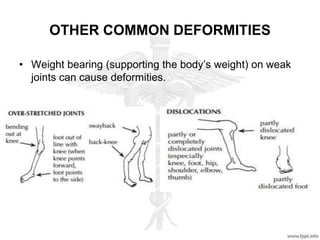OTHER COMMON DEFORMITIES
• Weight bearing (supporting the body’s weight) on weak
joints can cause deformities.
 