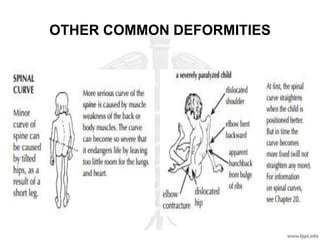OTHER COMMON DEFORMITIES
 