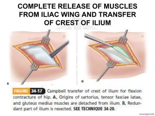 COMPLETE RELEASE OF MUSCLES
FROM ILIAC WING AND TRANSFER
OF CREST OF ILIUM
 