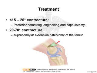 Treatment
• <15 – 20* contracture:
– Posterior hamstring lengthening and capsulotomy.
• 20-70* contracture:
– supracondylar extension osteotomy of the femur
 