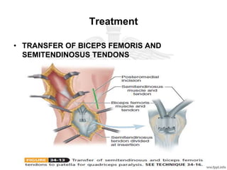 Treatment
• TRANSFER OF BICEPS FEMORIS AND
SEMITENDINOSUS TENDONS
 
