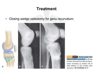 Treatment
• Closing wedge osteotomy for genu recurvatum.
 