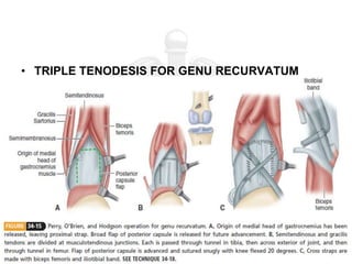 • TRIPLE TENODESIS FOR GENU RECURVATUM
 