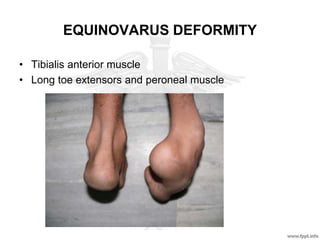 EQUINOVARUS DEFORMITY
• Tibialis anterior muscle
• Long toe extensors and peroneal muscle
 