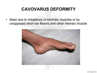 CAVOVARUS DEFORMITY
• Seen due to imbalance of extrinsic muscles or by
unopposed short toe flexors and other intrinsic muscle
 