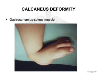 CALCANEUS DEFORMITY
• Gastroconemius-soleus muscle
 