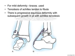 • For mild deformity –braces used
• Tenodesis of achilles tendon to fibula
• There is progressive equinous deformity with
subsequent growth in pt with achilles tenodesis
 