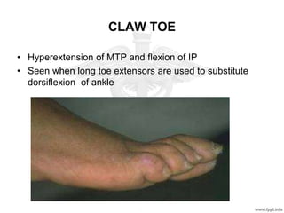 CLAW TOE
• Hyperextension of MTP and flexion of IP
• Seen when long toe extensors are used to substitute
dorsiflexion of ankle
 