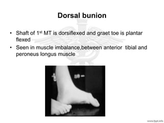Dorsal bunion
• Shaft of 1st MT is dorsiflexed and graet toe is plantar
flexed
• Seen in muscle imbalance,between anterior tibial and
peroneus longus muscle
 