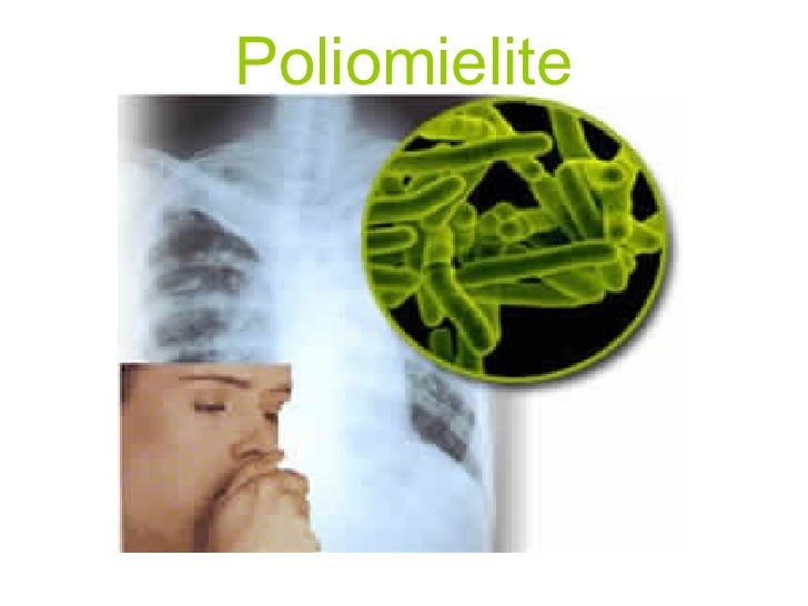 Poliomielite