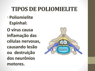 TIPOS DE POLIOMIELITE
•Poliomielite
Espinhal:
O vírus causa
inflamação das
células nervosas,
causando lesão
ou destruição
dos neurônios
motores.
 