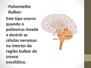 •Poliomielite
Bulbar:
Este tipo ocorre
quando o
poliovírus invade
e destrói as
células nervosas
no interior da
região bulbar do
tronco
encefálico.
 
