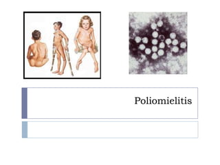Poliomielitis

 