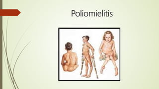 Poliomielitis
 