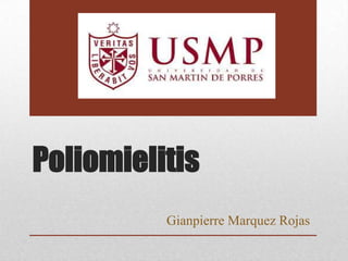 Poliomielitis
Gianpierre Marquez Rojas
 