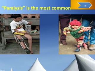 “Paralysis” is the most common
4
2
 
