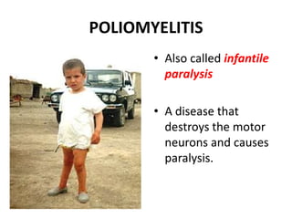POLIOMYELITIS Also called infantile paralysis A disease that destroys the motor neurons and causes paralysis. 