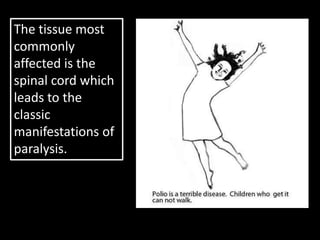 The tissue most
commonly
affected is the
spinal cord which
leads to the
classic
manifestations of
paralysis.