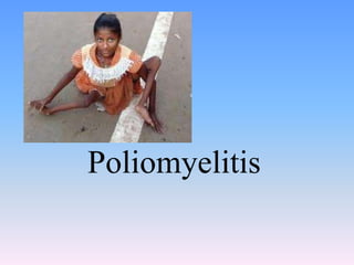 Poliomyelitis
 