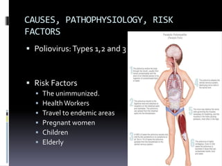 CAUSES, PATHOPHYSIOLOGY, RISK
FACTORS
 Poliovirus:Types 1,2 and 3
 Risk Factors
 The unimmunized.
 HealthWorkers
 Travel to endemic areas
 Pregnant women
 Children
 Elderly
 