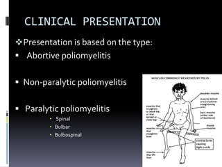 CLINICAL PRESENTATION
Presentation is based on the type:
 Abortive poliomyelitis
 Non-paralytic poliomyelitis
 Paralytic poliomyelitis
• Spinal
• Bulbar
• Bulbospinal
 
