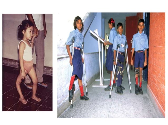 Poliomyelitis | PPT