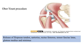 Ober-Yount procedure
Release of Iliopsoas tendon, sartorius, rectus femorus, tensor fasciae latae,
gluteus medius and minimus
 
