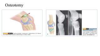 Osteotomy
 