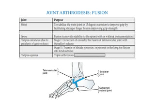 JOINT ARTHRODESIS: FUSION
 