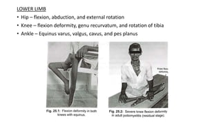 LOWER LIMB
• Hip – flexion, abduction, and external rotation
• Knee – flexion deformity, genu recurvatum, and rotation of tibia
• Ankle – Equinus varus, valgus, cavus, and pes planus
 