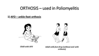 ORTHOSIS – used in Poliomyelitis
1) AFO – ankle-foot orthosis
 