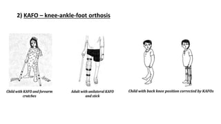 2) KAFO – knee-ankle-foot orthosis
 