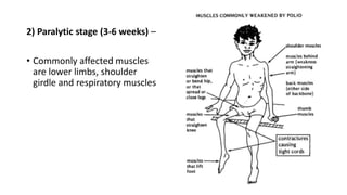 2) Paralytic stage (3-6 weeks) –
• Commonly affected muscles
are lower limbs, shoulder
girdle and respiratory muscles
 