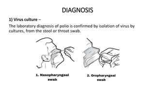 DIAGNOSIS
1) Virus culture –
The laboratory diagnosis of polio is confirmed by isolation of virus by
cultures, from the stool or throat swab.
 