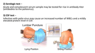 2) Serologic test –
Acute and convalescent serum sample may be tested for rise in antibody titer
(antibodies to the poliovirus).
3) CSF test –
Infection with polio virus may cause an increased number of WBCs and a mildly
elevated protein level in CSF.
 