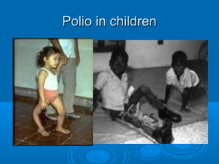 Polio in childrenPolio in children
 