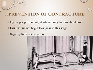 PREVENTION OF CONTRACTURE
• By proper positioning of whole body and involved limb
• Contracture are begin to appear in this stage
• Rigid splints can be given
 