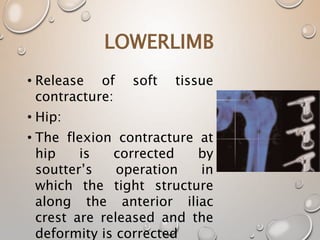 LOWERLIMB
• Release of soft tissue
contracture:
• Hip:
• The flexion contracture at
hip is corrected by
soutter’s operation in
which the tight structure
along the anterior iliac
crest are released and the
deformity is corrected
 