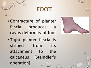 FOOT
• Contracture of planter
fascia produces a
cavus deformity of foot
• Tight planter fascia is
striped from its
attachment to the
calcaneus [Steindler's
operation]
 