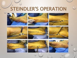 STEINDLER'S OPERATION
 