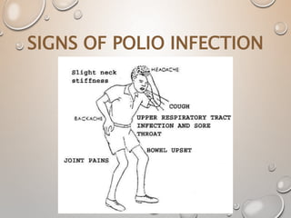 SIGNS OF POLIO INFECTION
 