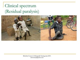 Clinical spectrum
(Residual paralysis)
Refresher Course in Orthopaedic Nursing, June 2019.
doctoraroju@yahoo.com
 